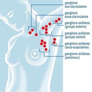 Ganglions seins ? Facteurs de risque du cancer du sein